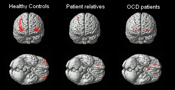 Health Rounds: Scientists find genes linked to OCD, raising the prospect of new treatments-